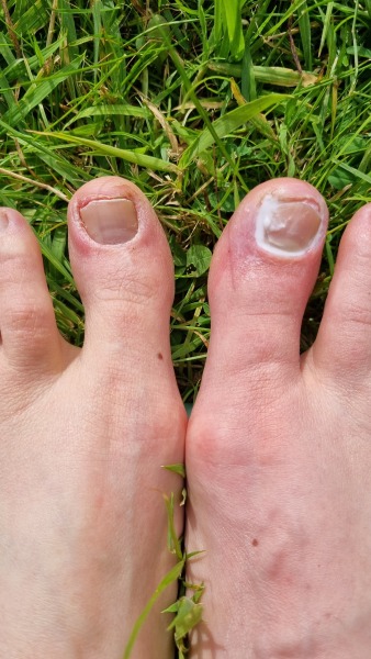 What is up with my toe?!