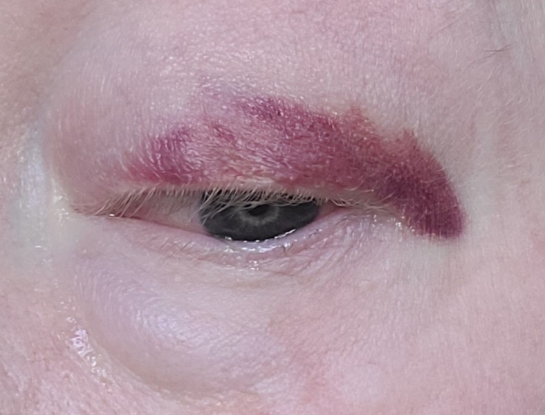 Does this eyelid need to be looked at?