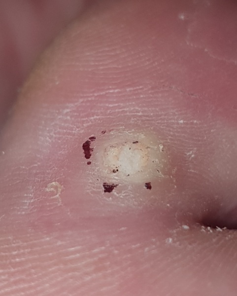 Is this a verruca still?? Picture attached