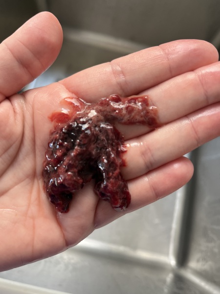 TMI pics - D&C 3 weeks postpartum - retained products and blood clots