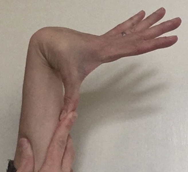 Anyone with Joint hypermobility or EDS?