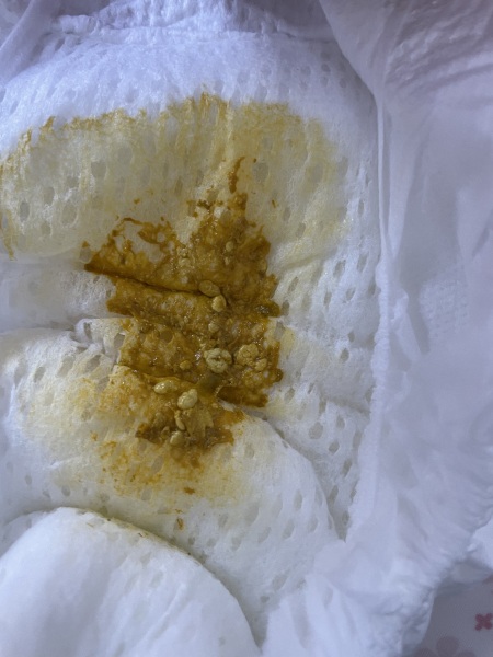 Newborn poop - CMPA? Warning nappy pic