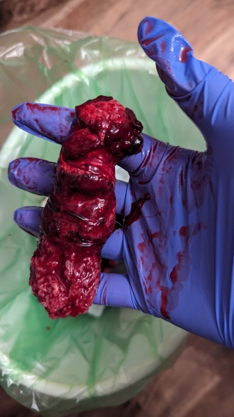 TRIGGER WARNING MISCARRIAGE PHOTO