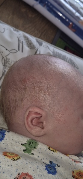 Does this look like baby acne or an allergy?