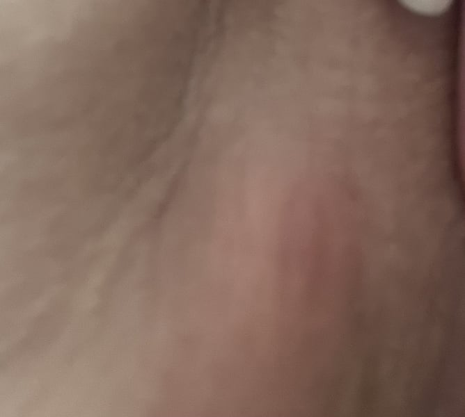 Painful lump in groin area