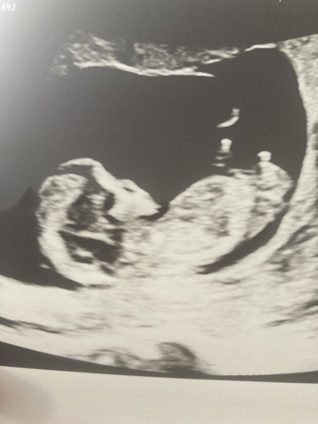 Sonographer did a bit of nub theory