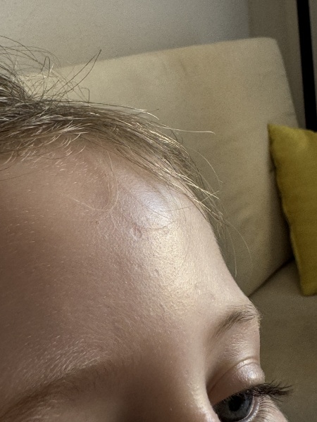 Severe chicken pox help!