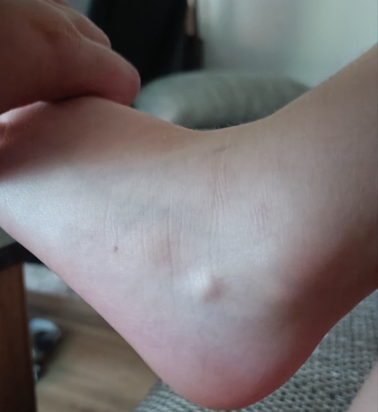 Lump on the foot