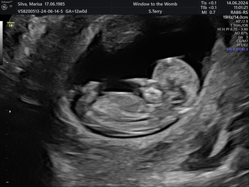 Boy or girl? 12 week scan