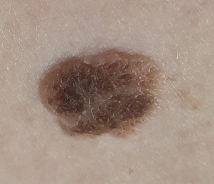 Mole okay, or mole not okay?