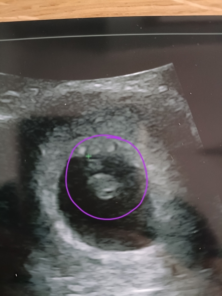 Multiple Chemical Pregnancies - Success Stories Welcomed