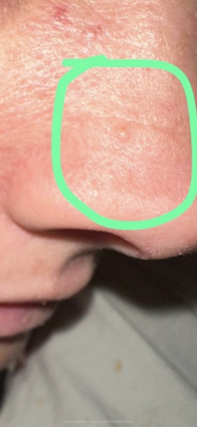 My sister sent me this is it bcc skin cancer