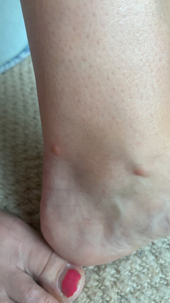 Horse fly bites? Photo