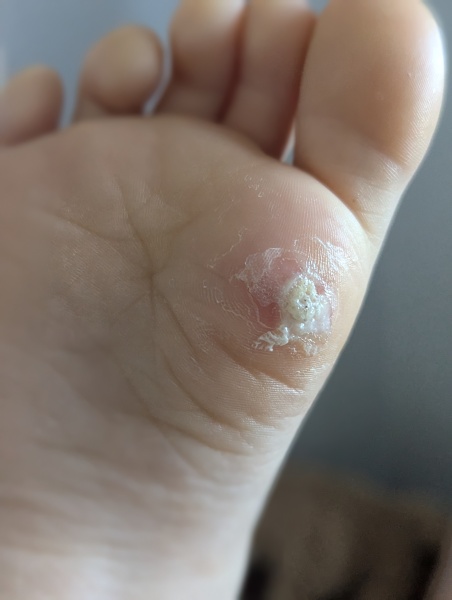 It's another verruca one (with photo)