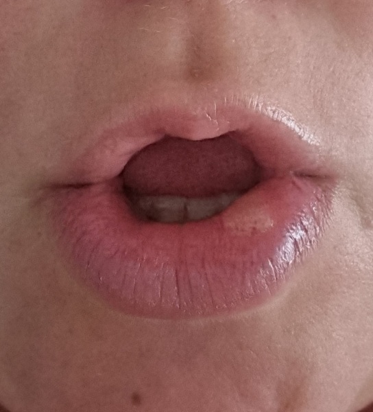 To ask what I can do with this huge ulcer (pic)