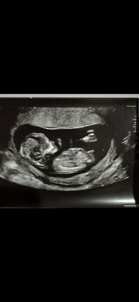 Boy or girl? Nub theory