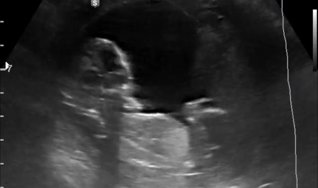 Nub / Gender - Ultrasound Tech wouldn’t commit! Opinions?