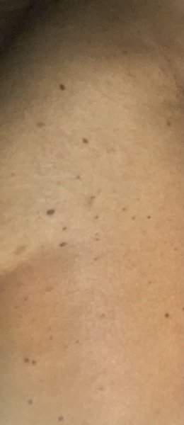 Papulosa nigra DPN/ seb keratosis