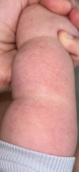 Anyone seen this rash before