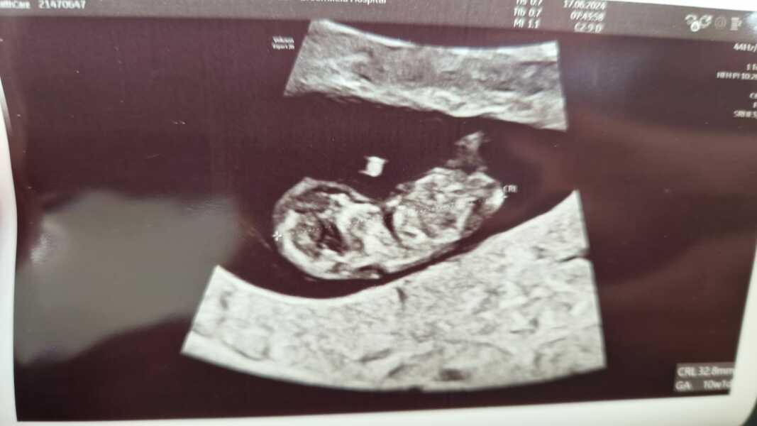 10 week scan, gender predictions