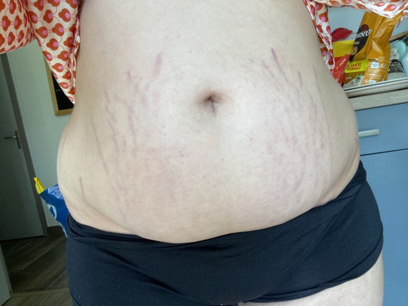 loose skin (help)
