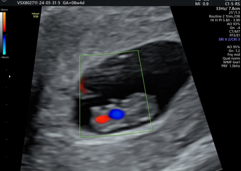 8 week abdominal scan - do I flip it?