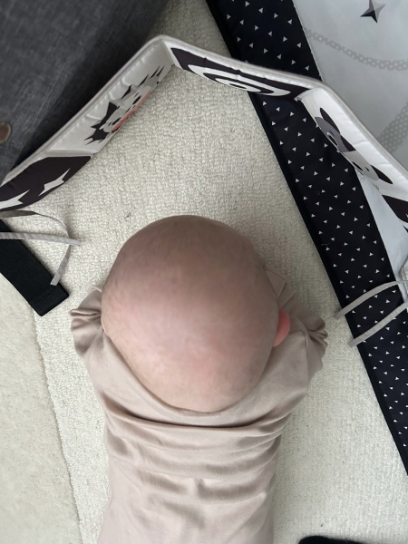 How severe is this plagiocephaly?