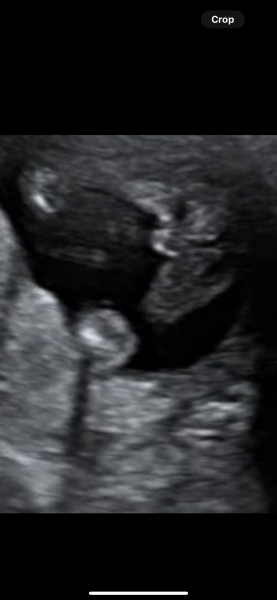 Can anyone tell gender from ultrasound scan ?