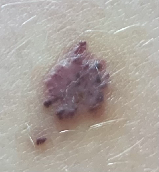 Any idea what this is on son's leg?