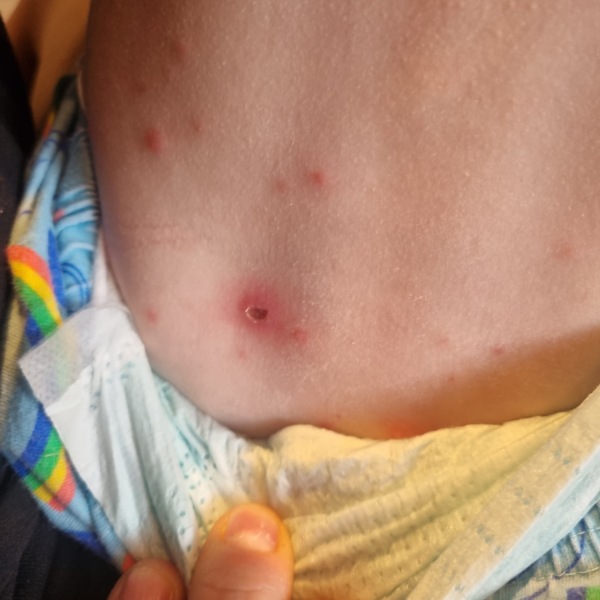 Chicken pox help