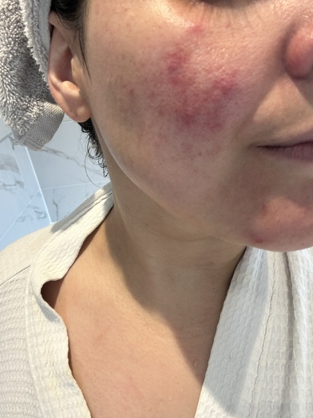 Rosacea