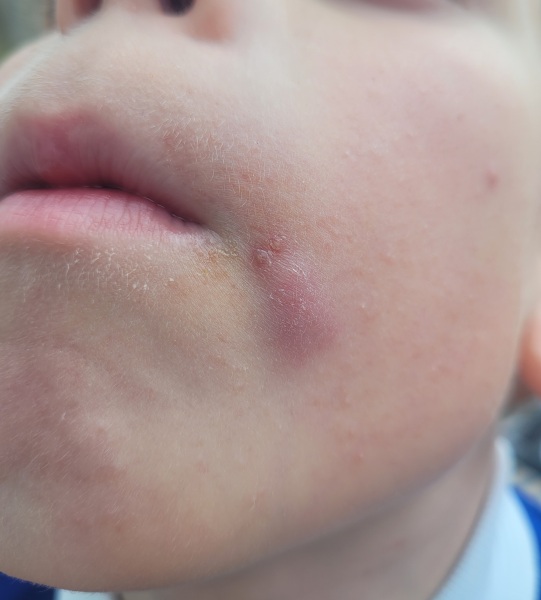 Raised lump on face