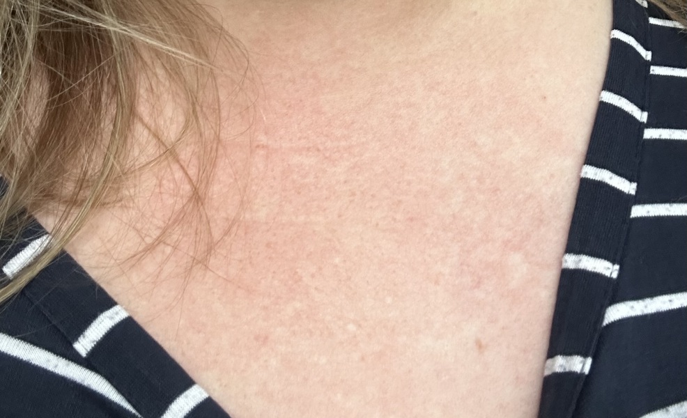 Scared woken up with this rash all over me