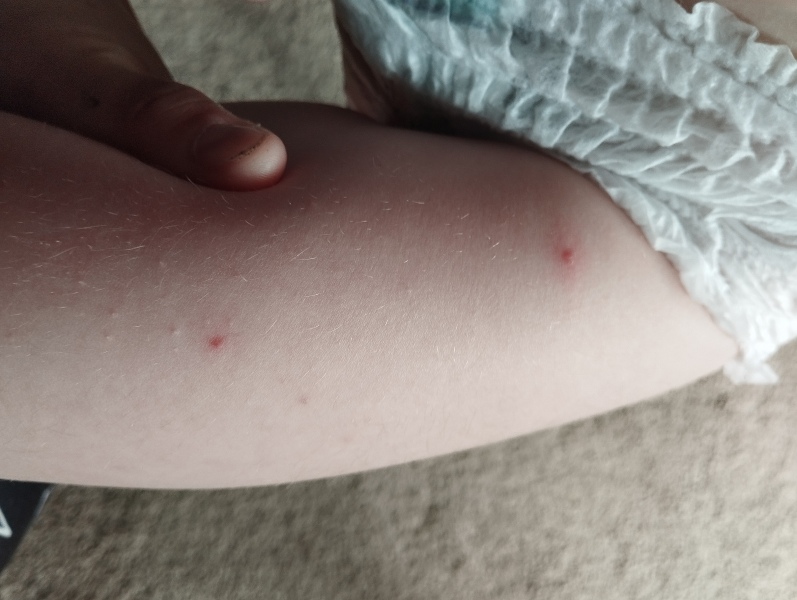 Chicken pox or something else?