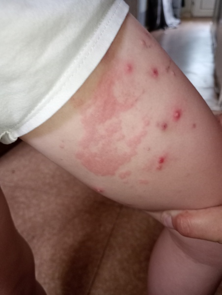 Circular rash