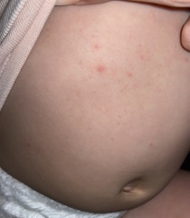 Chicken pox?