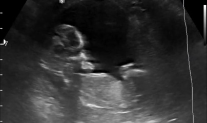 Nub / Gender - Ultrasound Tech wouldn’t commit! Opinions?