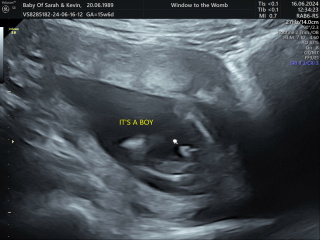 5 weeks 5 days early scan