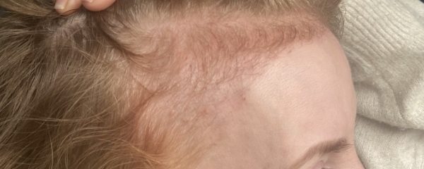 I’ve just had a hair transplant AMA