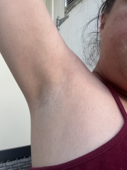 Worried about lump under armpit. I was recently diagnosed with the chek2 gene mutation