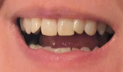 Invisalign - how much did yours cost and was it worth it?