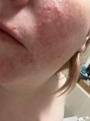 Acne or rosacea or?