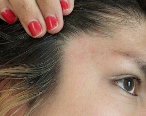Does this look like eczema to you?