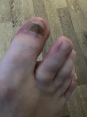 Accountability thread - disgusting toe nails includes photos
