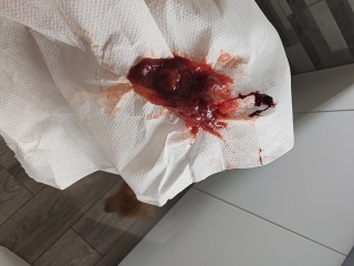 Is this a miscarriage or blood clot?