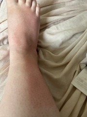 Rash and pains in all my joints