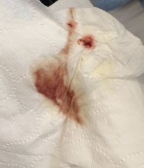 TW BLOOD PIC - advice!!