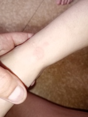 Circular rash