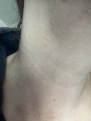 Cluster of warts / skin tags on neck