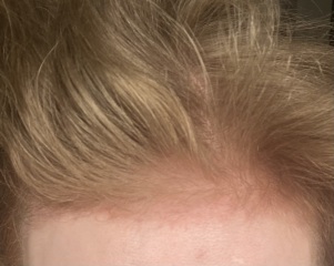 I’ve just had a hair transplant AMA